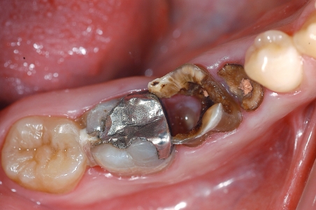 Distruzione struttura dentaria da carie