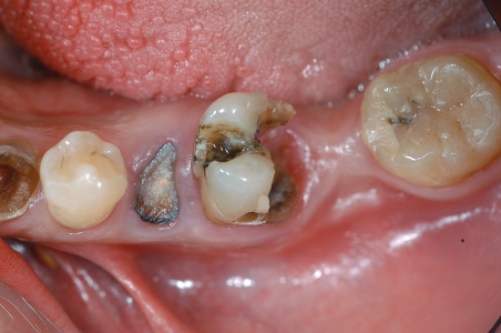 Distruzione struttura dentaria da carie