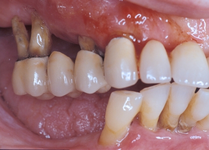 Distruzione dei tessuti di sostegno e ancoraggio dei denti (grave parodontopatia)