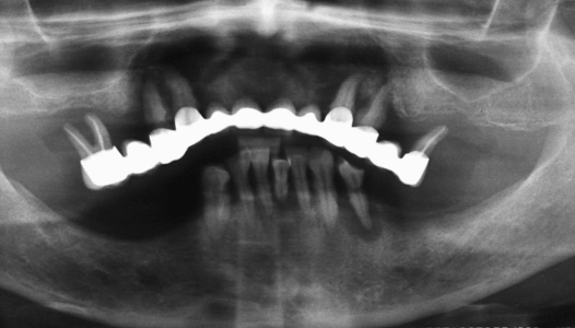 Distruzione dei tessuti di sostegno e ancoraggio dei denti (grave parodontopatia)