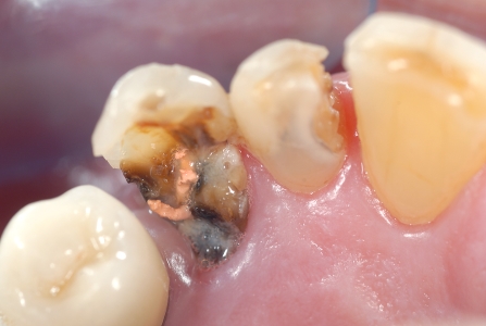 Necessità di rimuovere molta struttura dentale per correggere malposizione dentaria