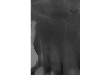 Elementi dentali distrutti da processi cariosi, perdita di oltre 50% tessuto coronale