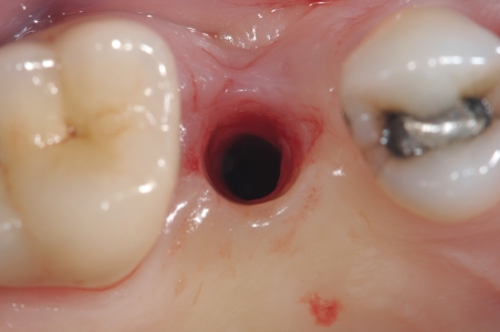 Ricostruzione denti devitalizzati con corona in ceramica