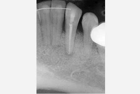 Chirurgia ossea ricostruttiva: eliminazione del difetto dopo…