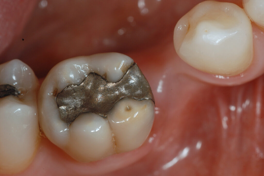 Rizectomia e rimozione radice mesiale