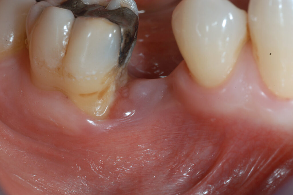 Rizectomia e rimozione radice mesiale