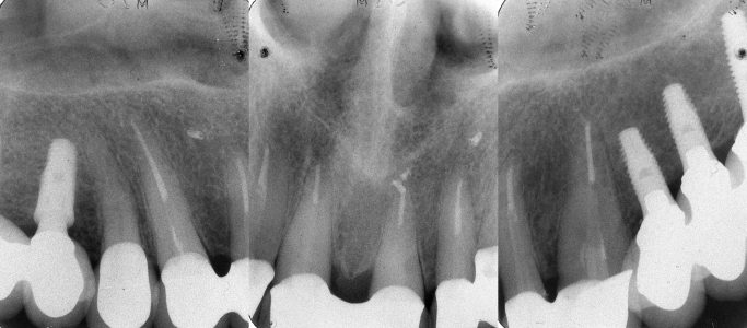 Ricostruzione finale con corone in ceramica