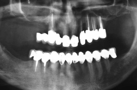 Ortopantomografia non dà informazioni su situazioni infiammatorie croniche (sinusite)