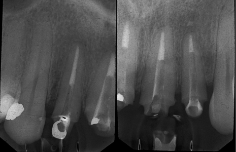 Estesa distruzione elementi dentali, ritrattamento canalare