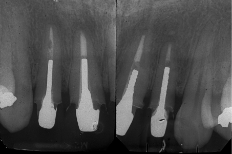 Ricostruzione indiretta monconi e corone in metallo ceramica